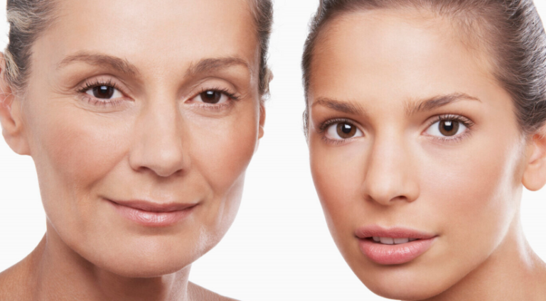 vampire facial using PRP platelet rich plasma to heal the skin after microneedling. For skin rejuvenation, fine lines and wrinkes, acne scarring, younger looking skin