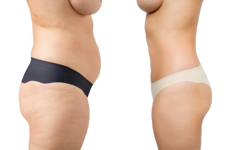 What are the Best Ways of Getting Rid of Stubborn Fat?