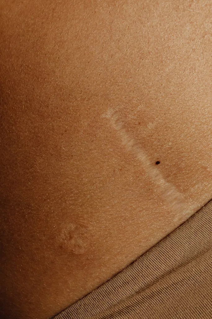 Close-up of Woman Body with Scar