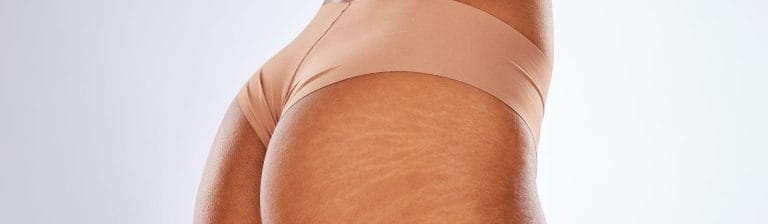 Getting Rid of Stretch Marks
