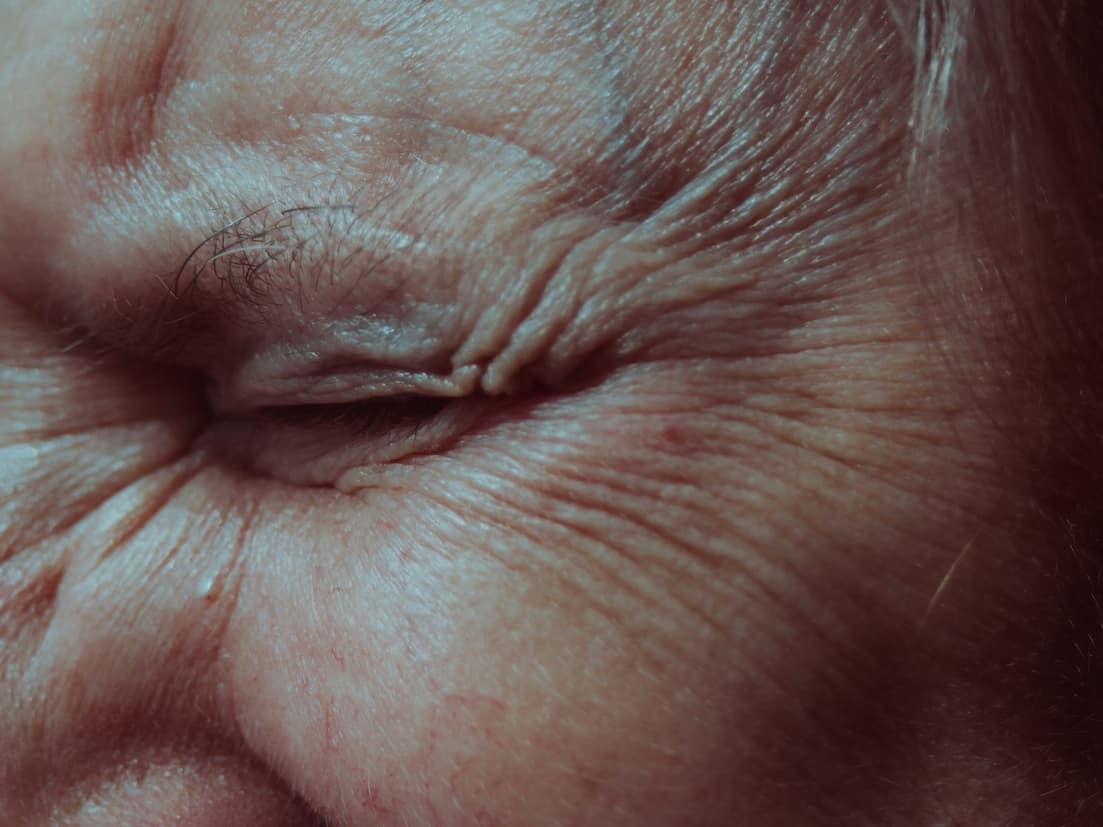 Volume Loss Wrinkles